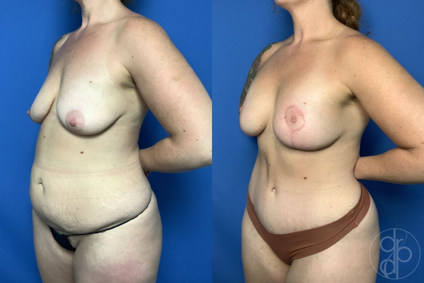 Before and after Abdominoplasty case 29689 - Angle 2