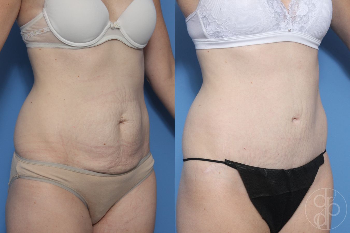 Before and after Abdominoplasty case 29570