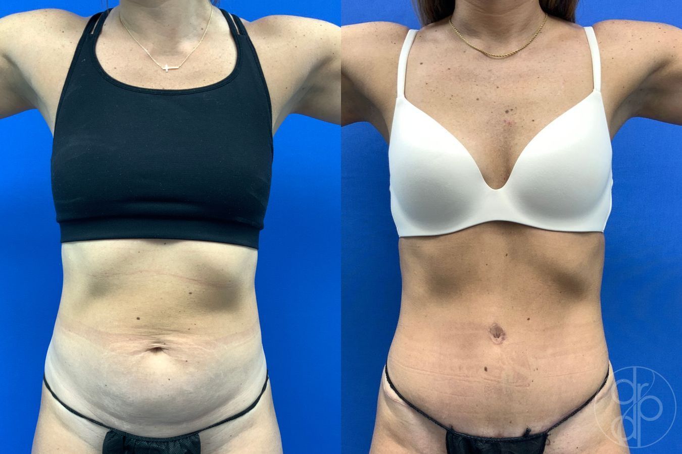 Before and after Abdominoplasty case 43175 - Angle 2