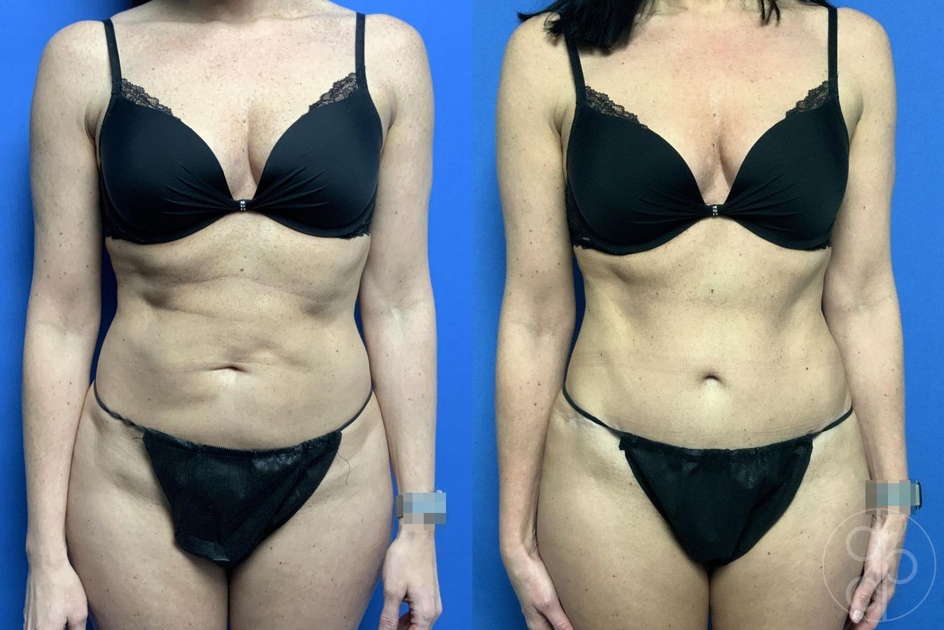 Before and after Abdominoplasty case 29613