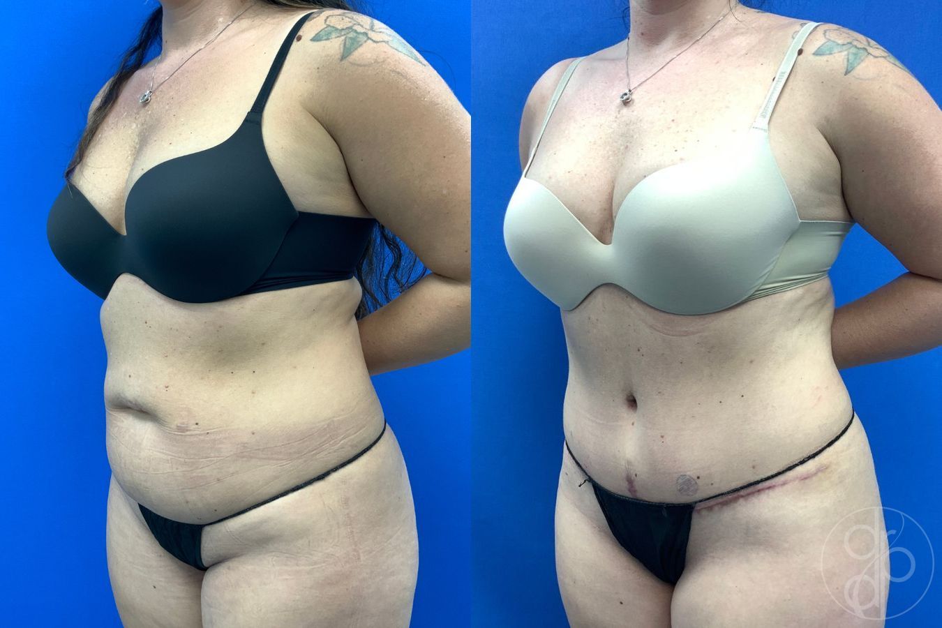 Before and after Abdominoplasty case 43461 - Angle 3
