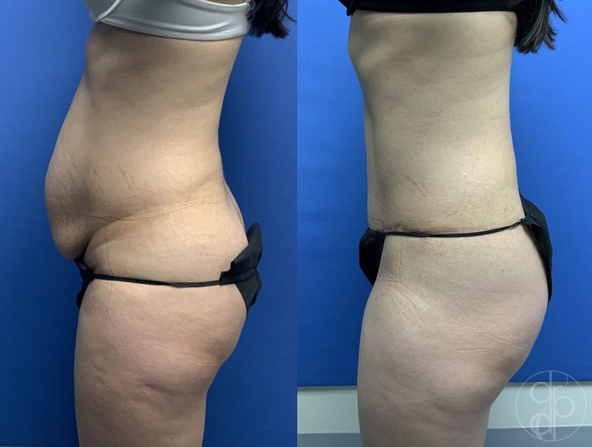 Before and after Abdominoplasty case 29565 - Angle 2