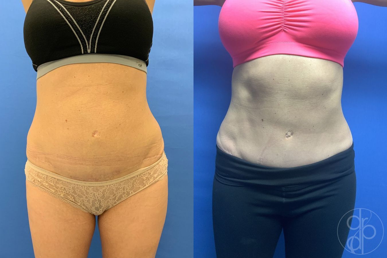 Before and after Abdominoplasty case 29572