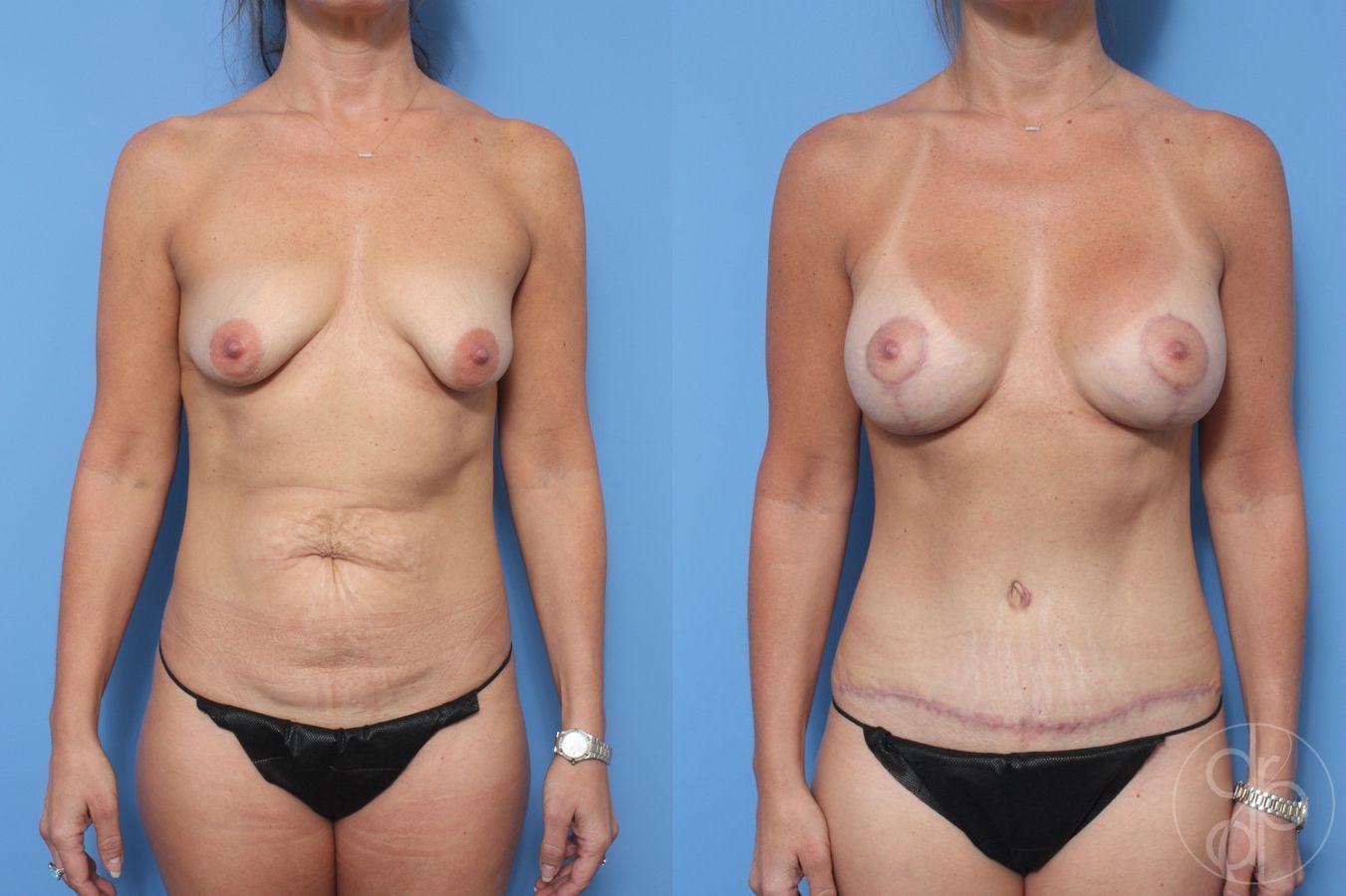 Before and after Abdominoplasty case 29684