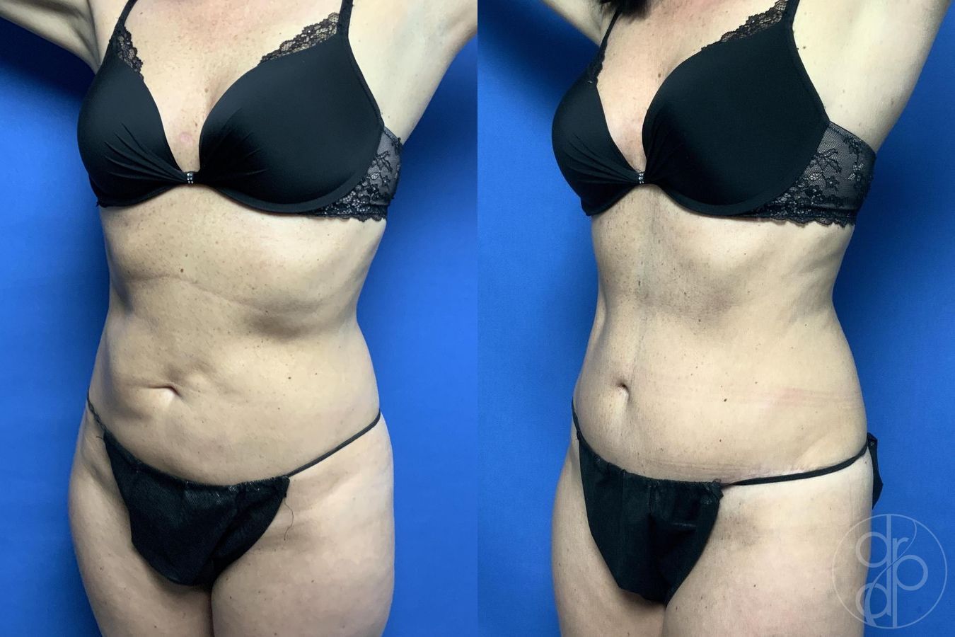 Before and after Abdominoplasty case 29613 - Angle 4
