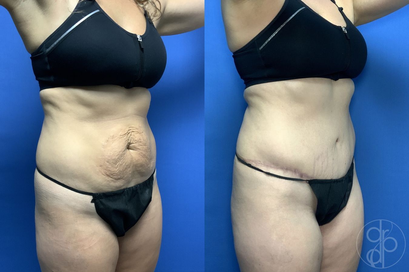 Before and after Abdominoplasty case 29574 - Angle 3