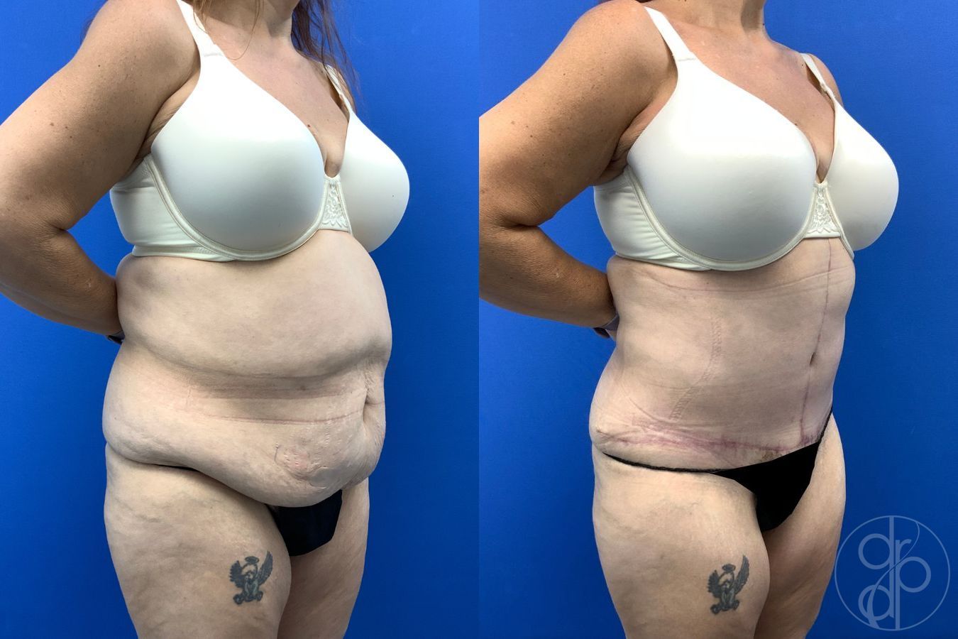 Before and after Abdominoplasty case 43458 - Angle 5