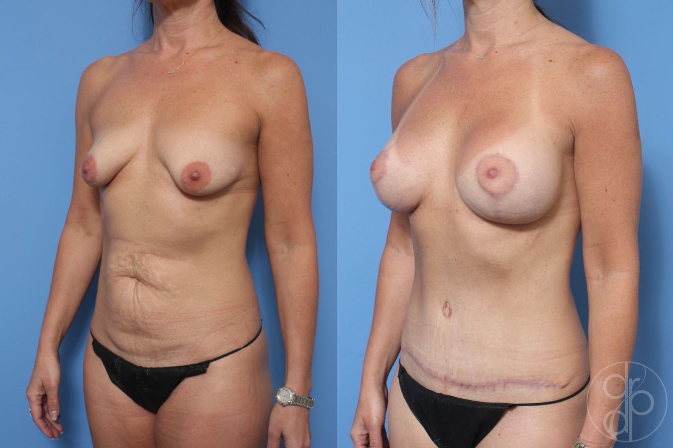 Before and after Abdominoplasty case 29684 - Angle 2