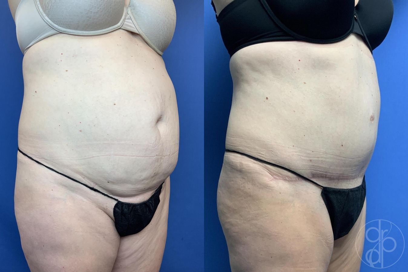 Before and after Abdominoplasty case 29586 - Angle 2