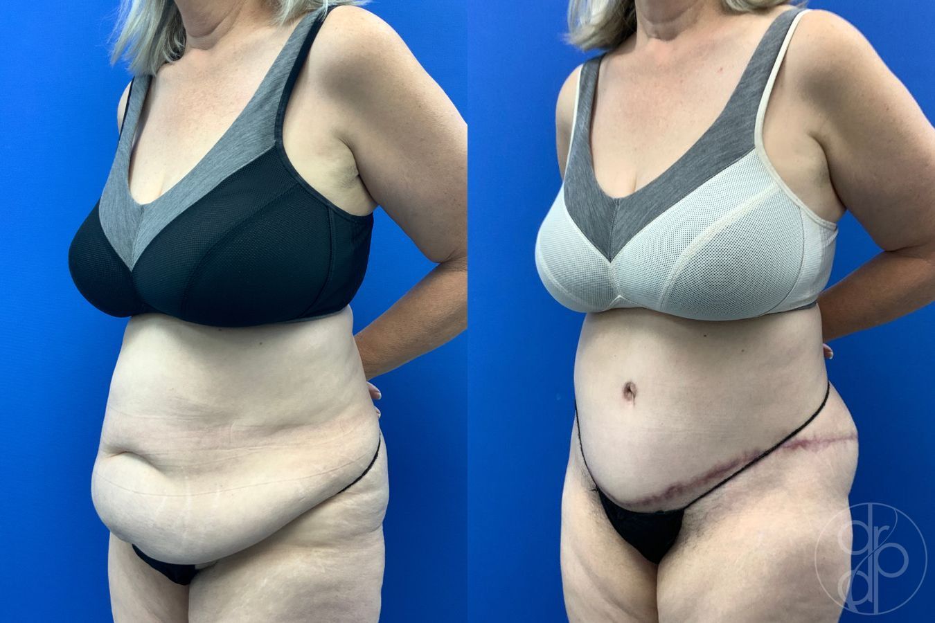 Before and after Abdominoplasty case 43487 - Angle 3
