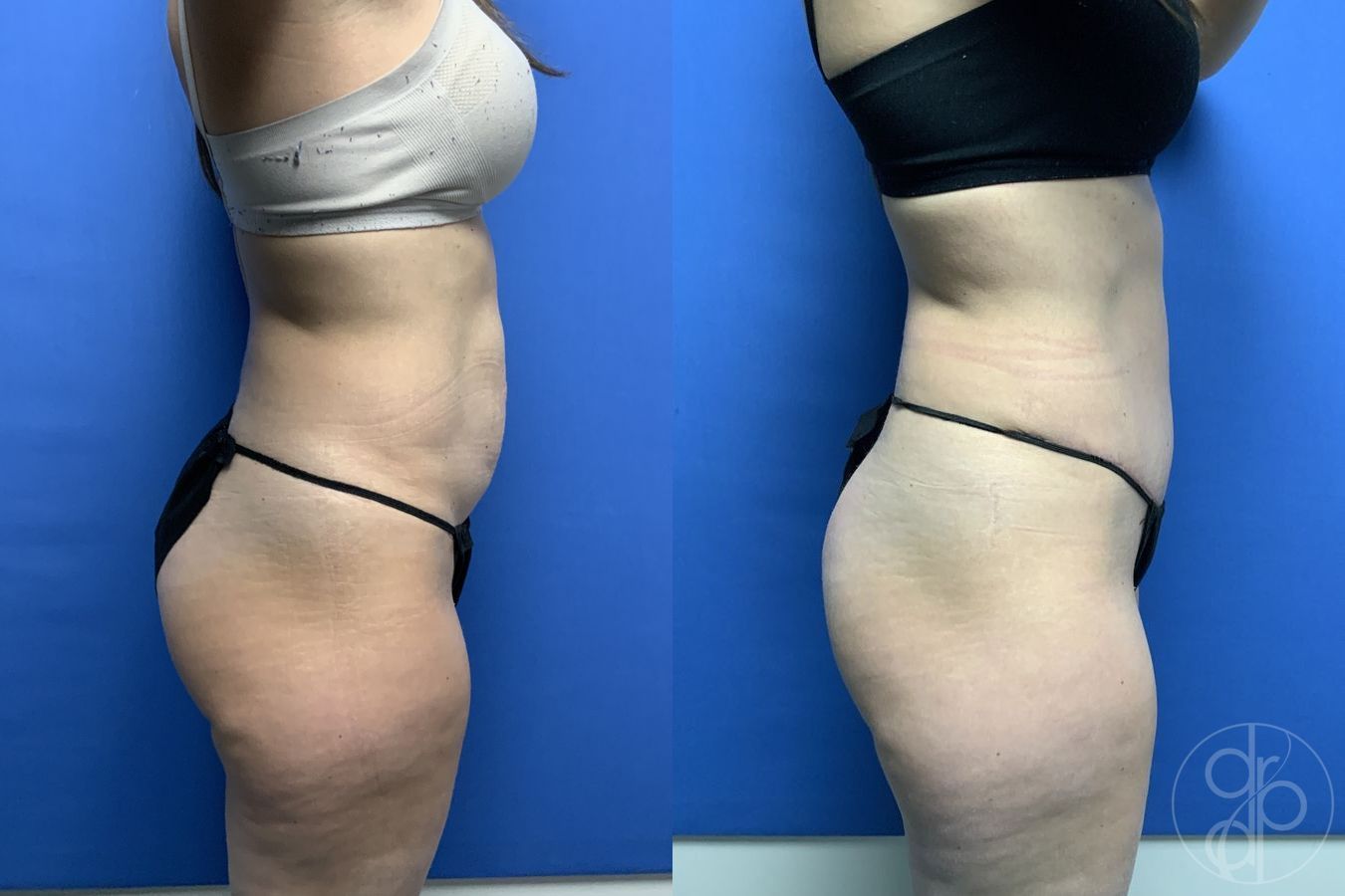 Before and after Abdominoplasty case 29580 - Angle 3