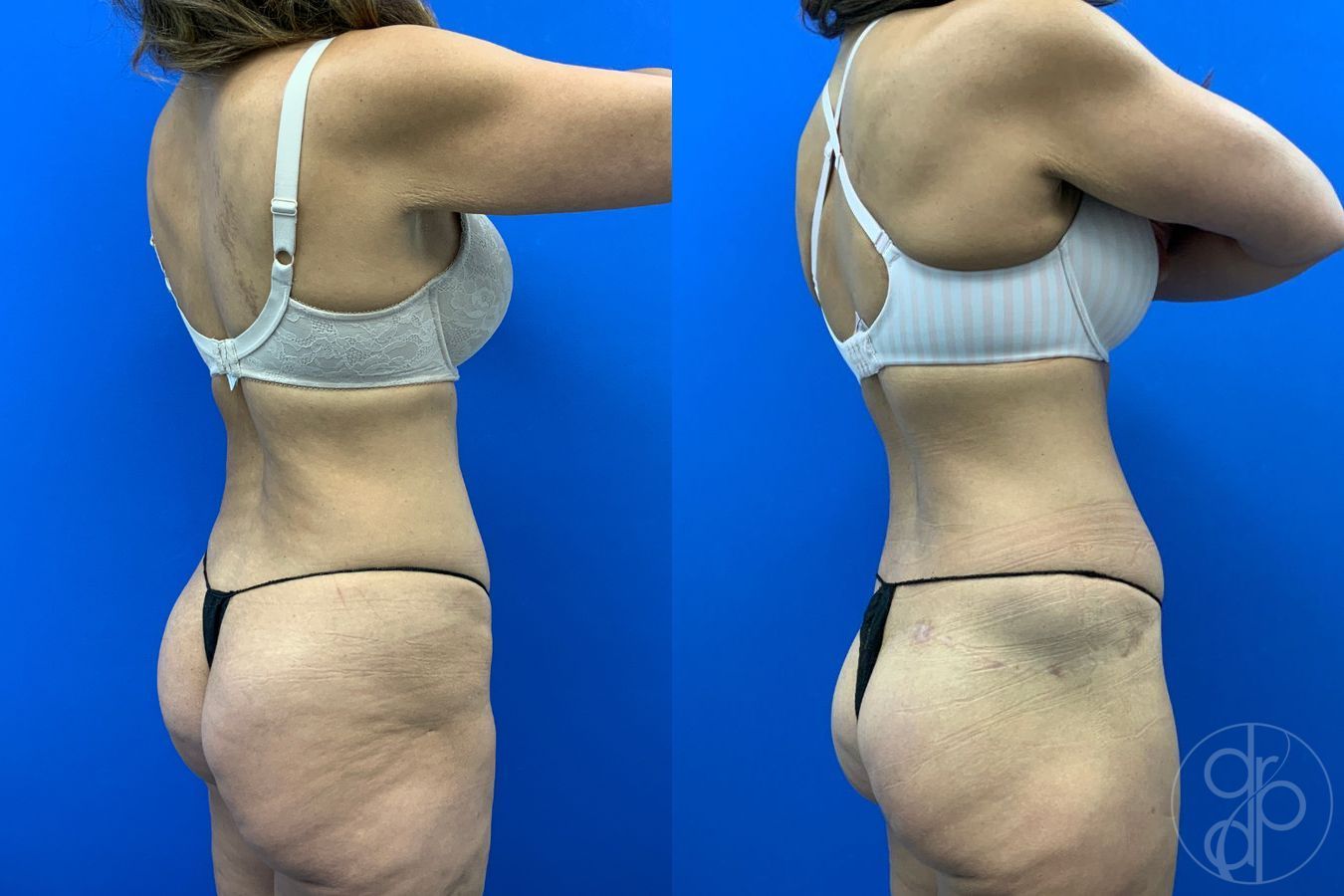 Before and after Abdominoplasty case 43480 - Angle 6