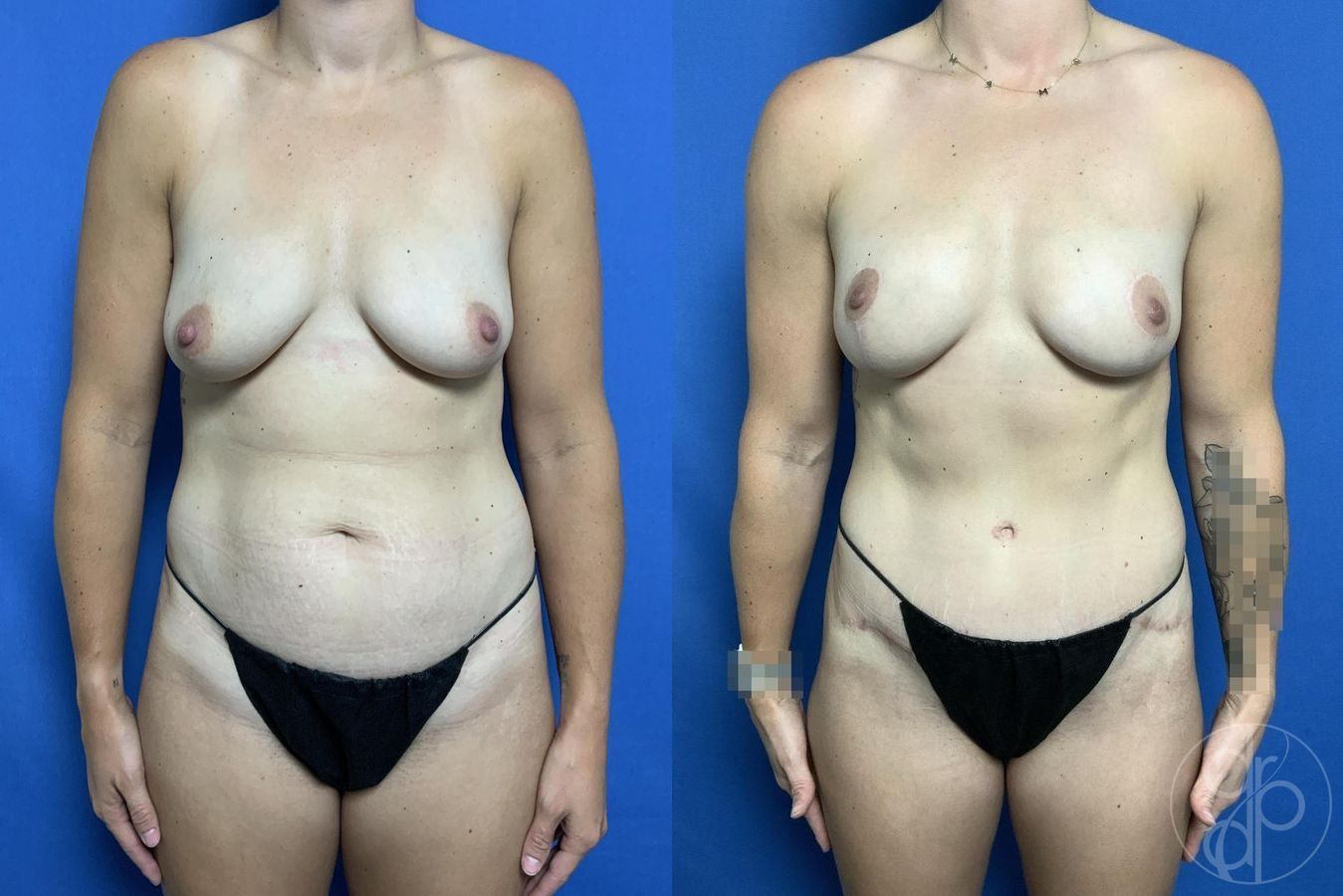 Before and after Abdominoplasty case 29656