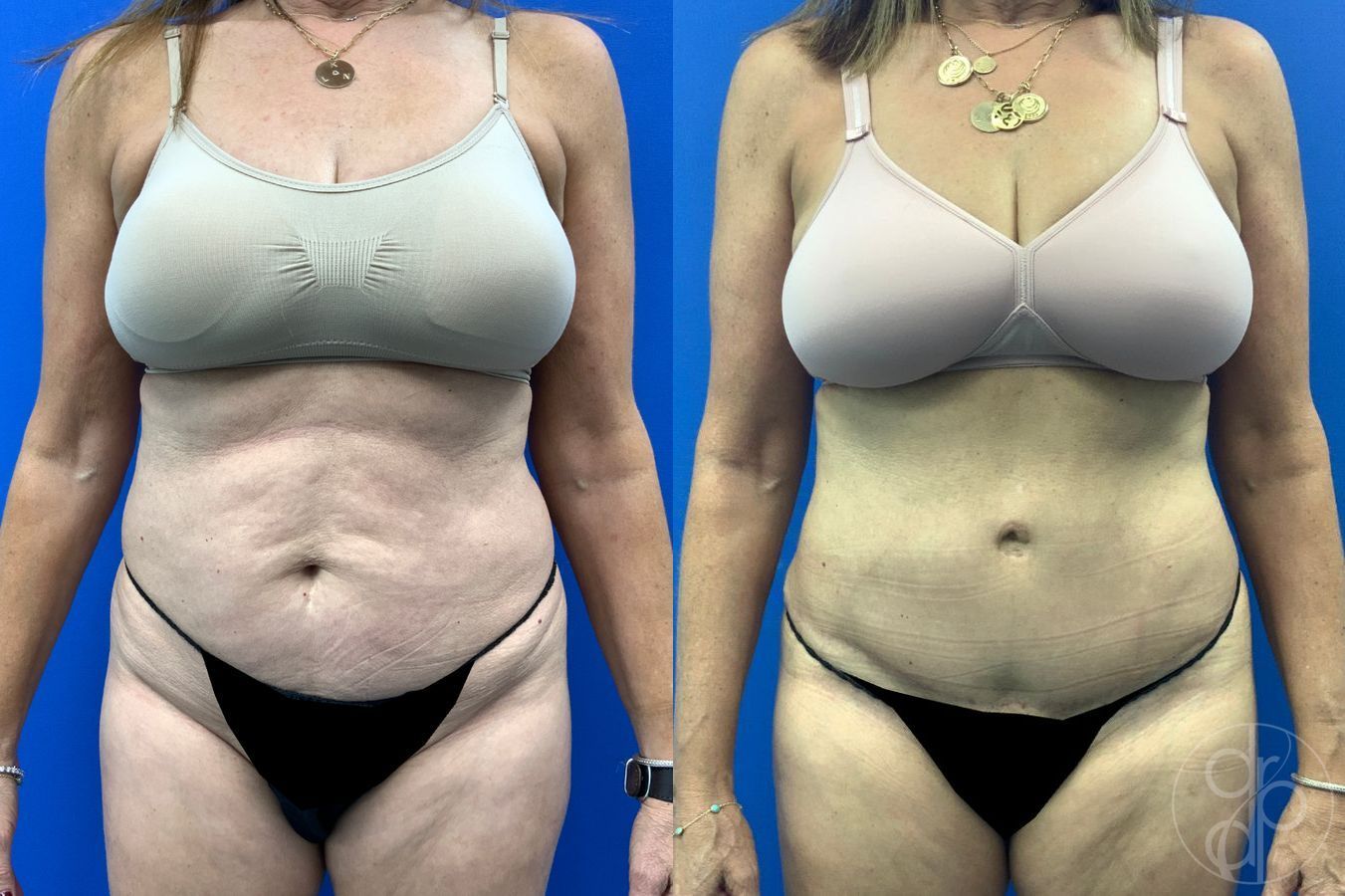 Before and after Abdominoplasty case 46404
