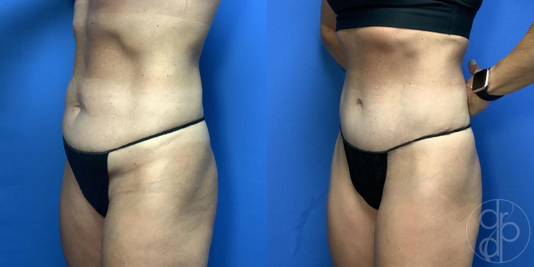 Before and after Abdominoplasty case 29994 - Angle 2