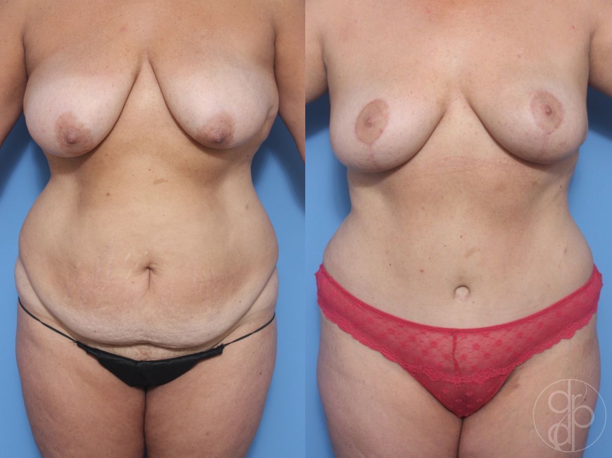 Before and after Abdominoplasty case 29695