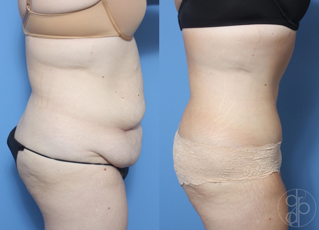 Before and after Abdominoplasty case 29544 - Angle 2