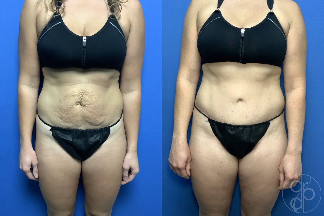Before and after Abdominoplasty case 29574