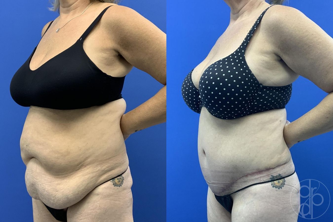 Before and after Abdominoplasty case 29619 - Angle 4