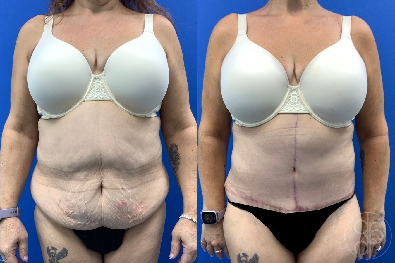 Before and after Abdominoplasty case 43458