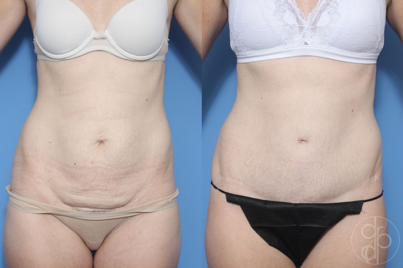 Before and after Abdominoplasty case 29570 - Angle 2