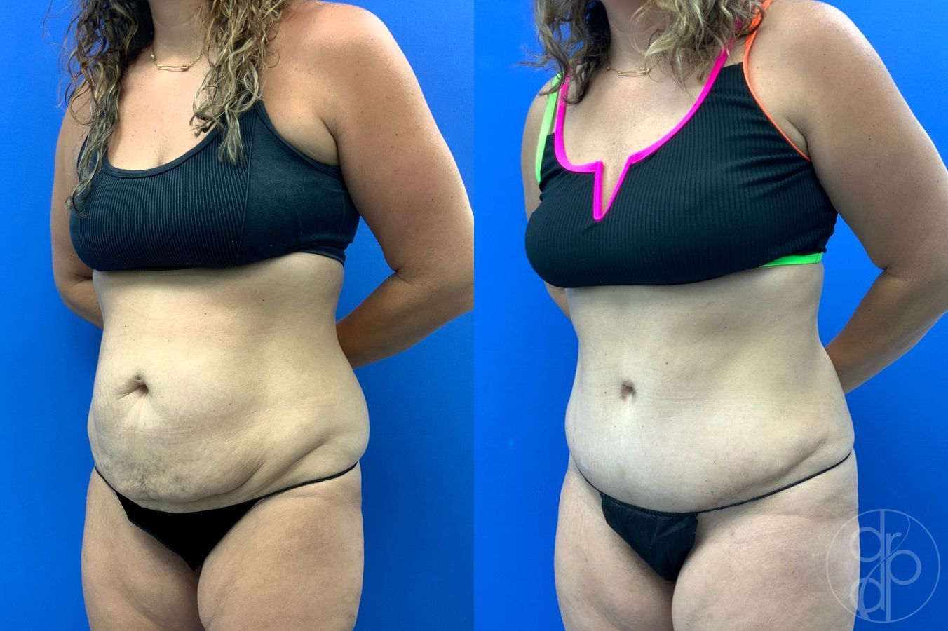 Before and after Liposuction case 43452 - Angle 9