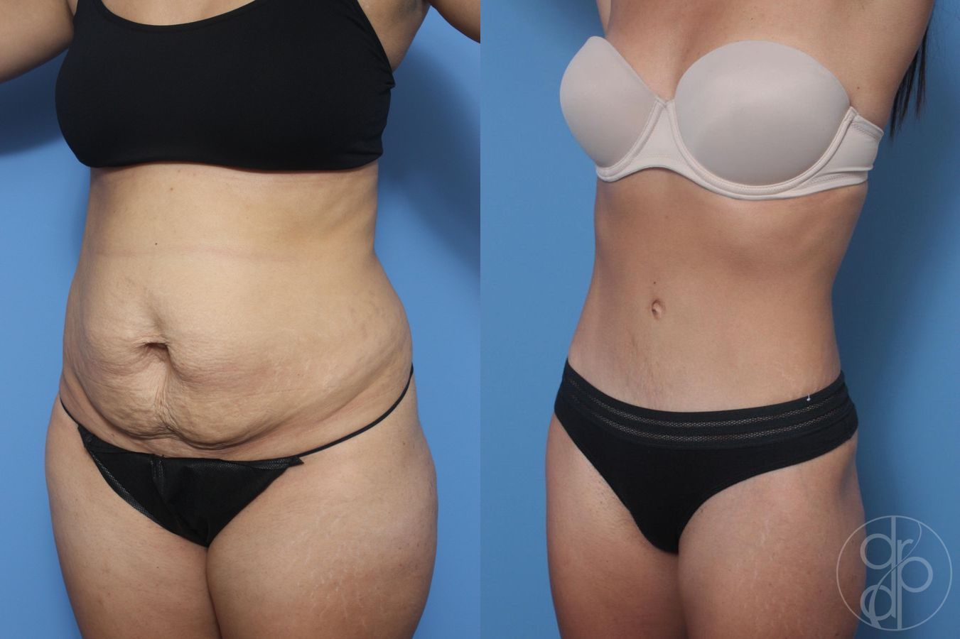 Before and after Abdominoplasty case 29531 - Angle 2
