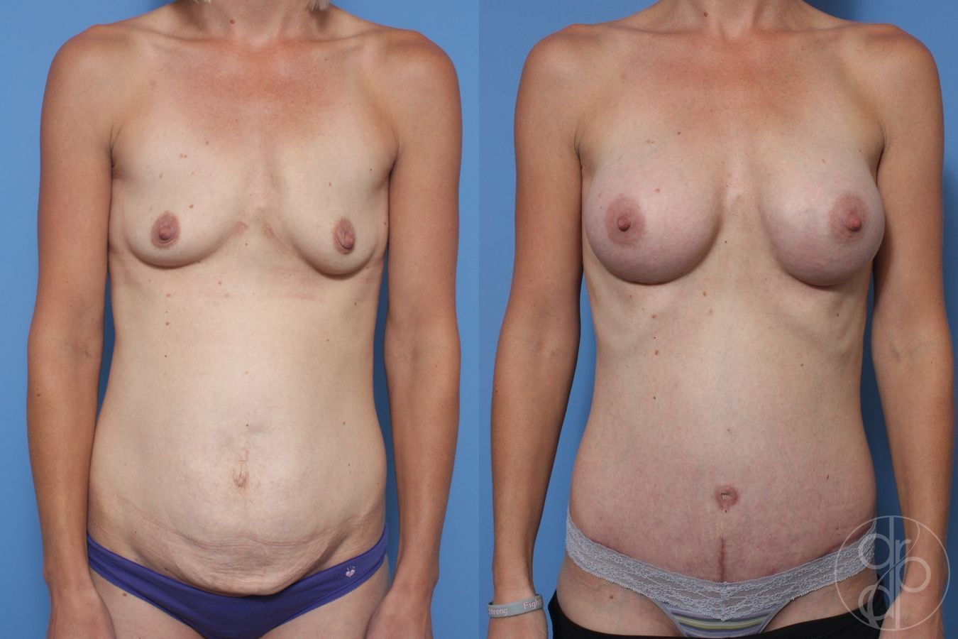 Before and after Abdominoplasty case 29692