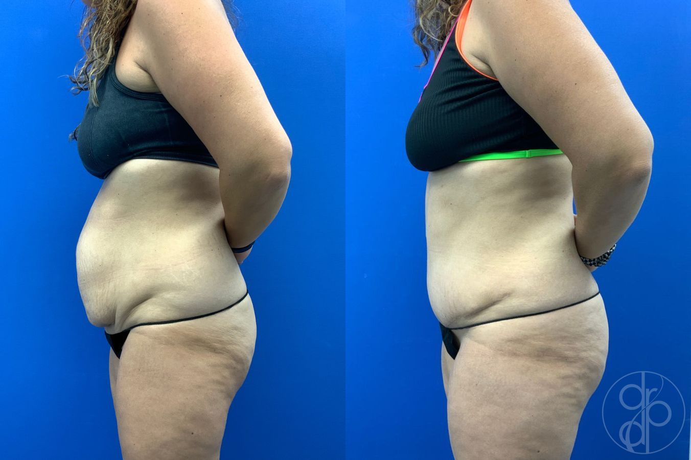 Before and after Liposuction case 43452 - Angle 8