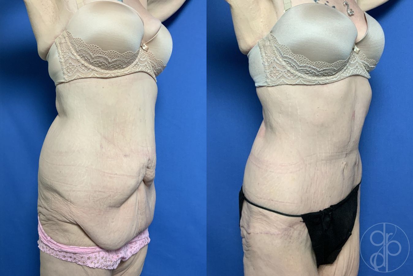 Before and after Abdominoplasty case 29535 - Angle 2