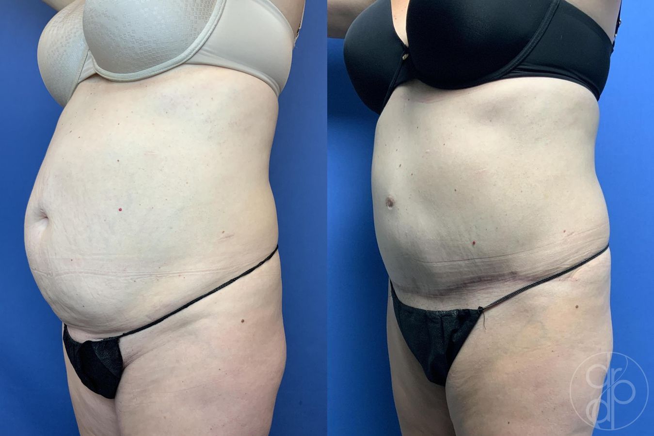 Before and after Abdominoplasty case 29586 - Angle 3