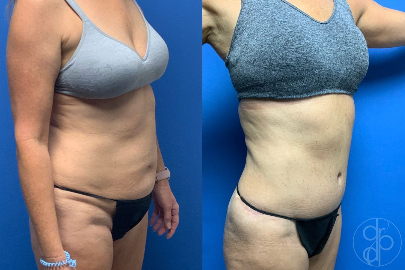 Before and after Liposuction case 46422 - Angle 6