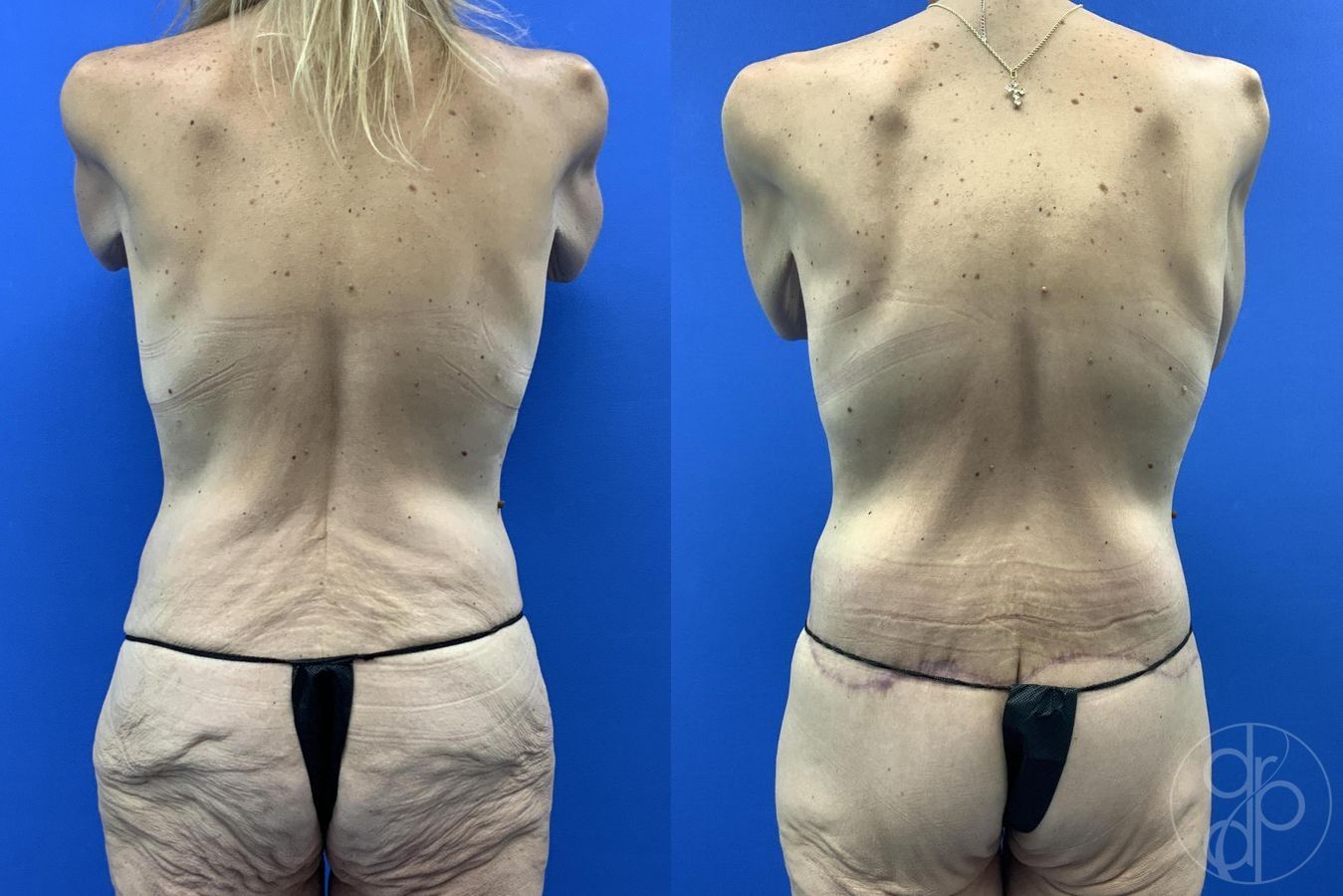 Before and after Abdominoplasty case 29983 - Angle 9