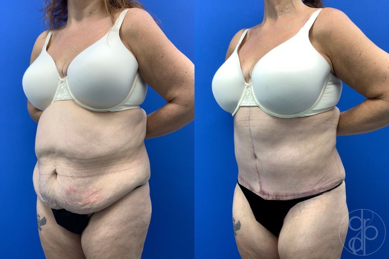Before and after Abdominoplasty case 43458 - Angle 3