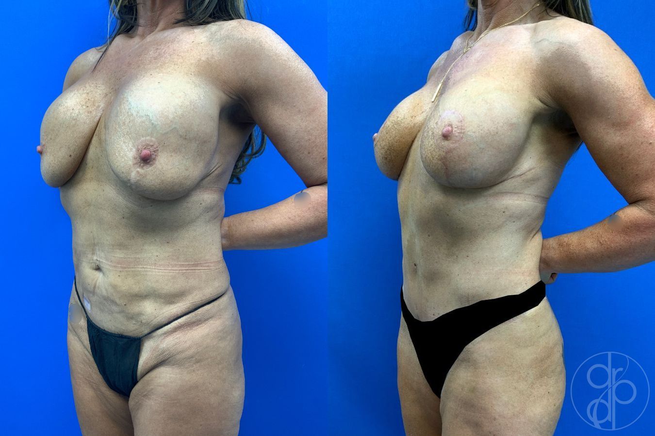 Before and after Mommy Makeover case 50316 - Angle 3