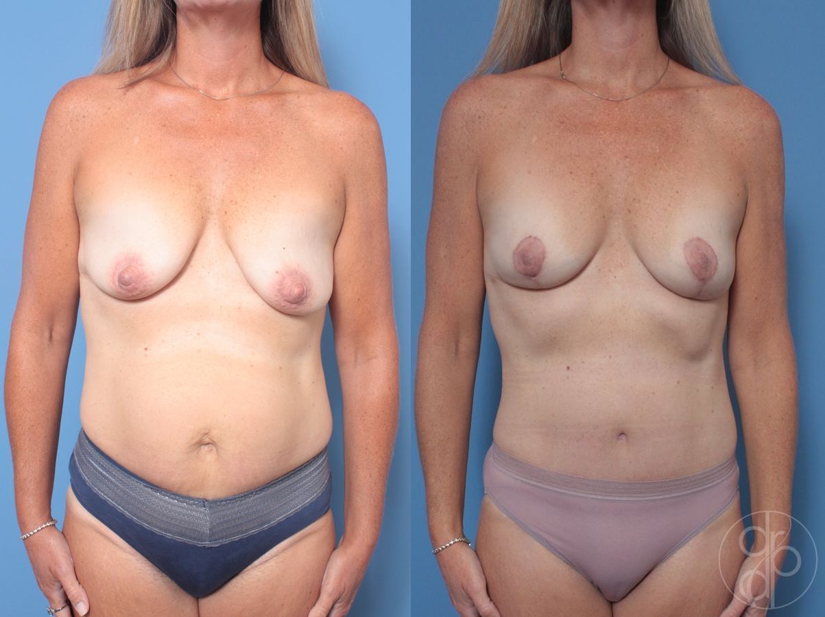 Before and after Abdominoplasty case 29665