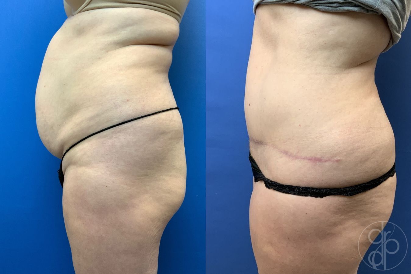 Before and after Abdominoplasty case 29579 - Angle 4