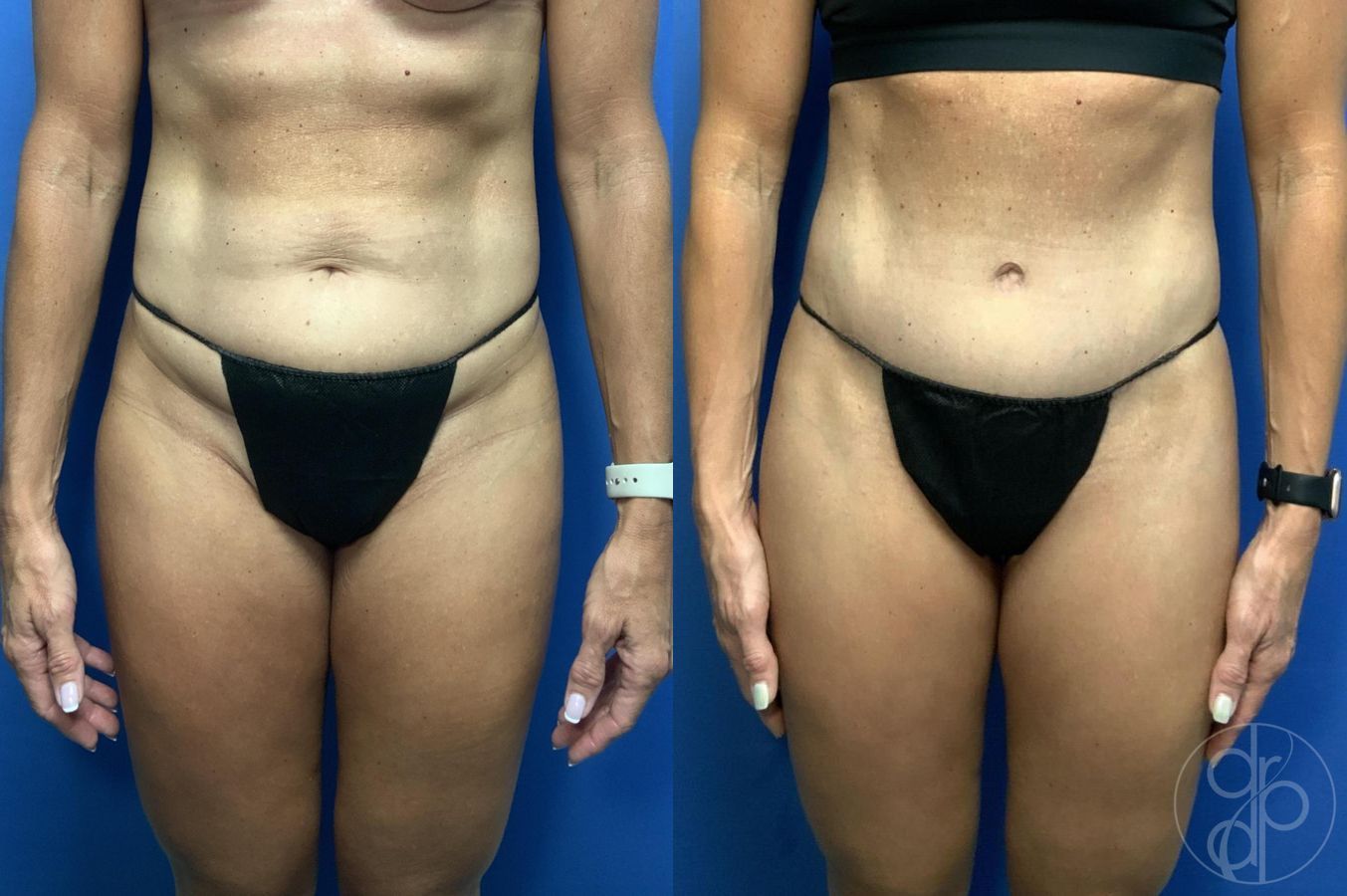 Before and after Abdominoplasty case 29994