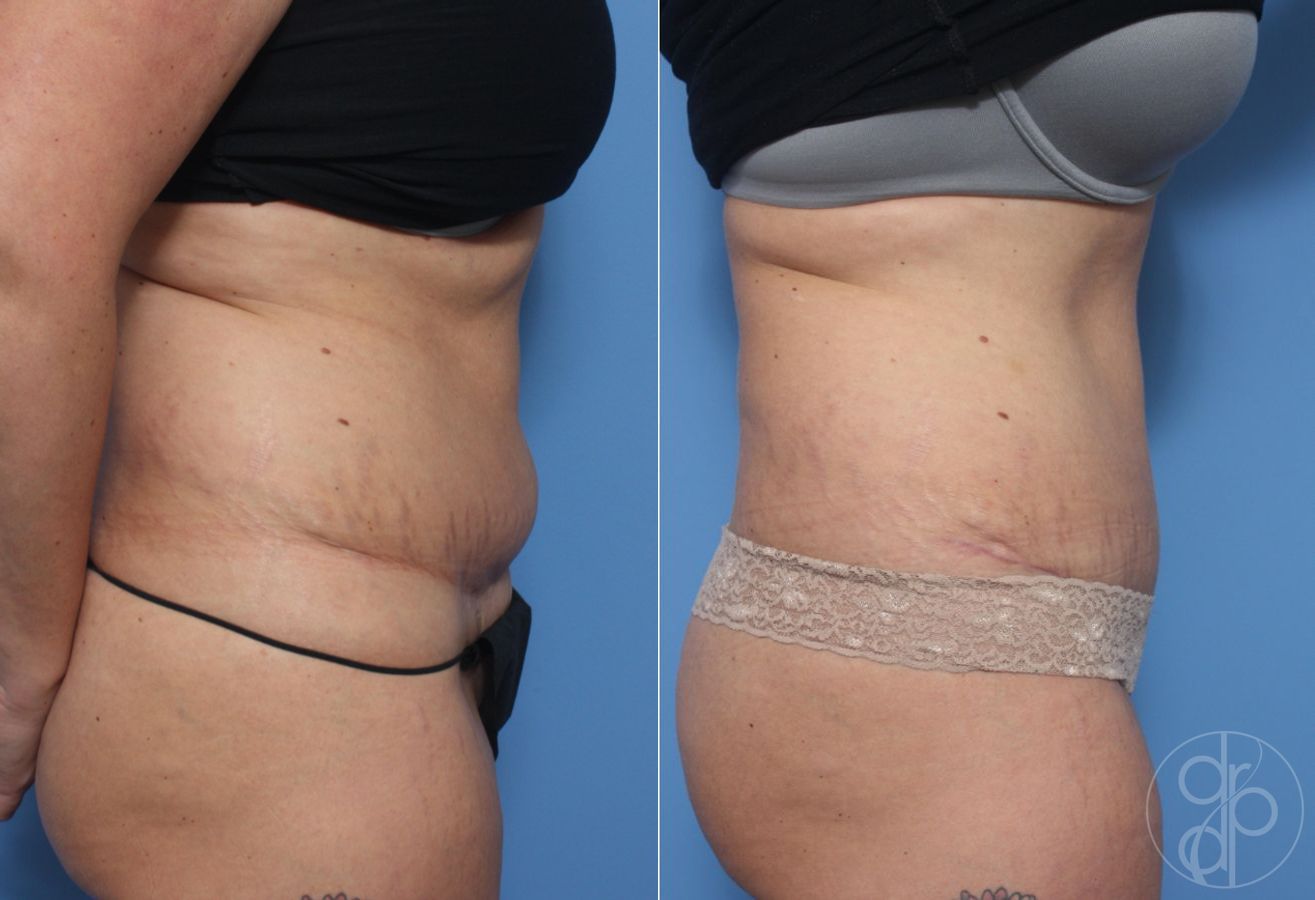 Before and after Abdominoplasty case 29550 - Angle 2