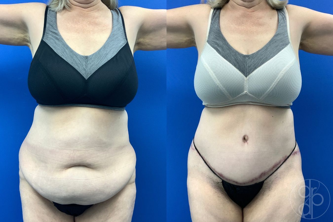 Before and after Abdominoplasty case 43487 - Angle 2