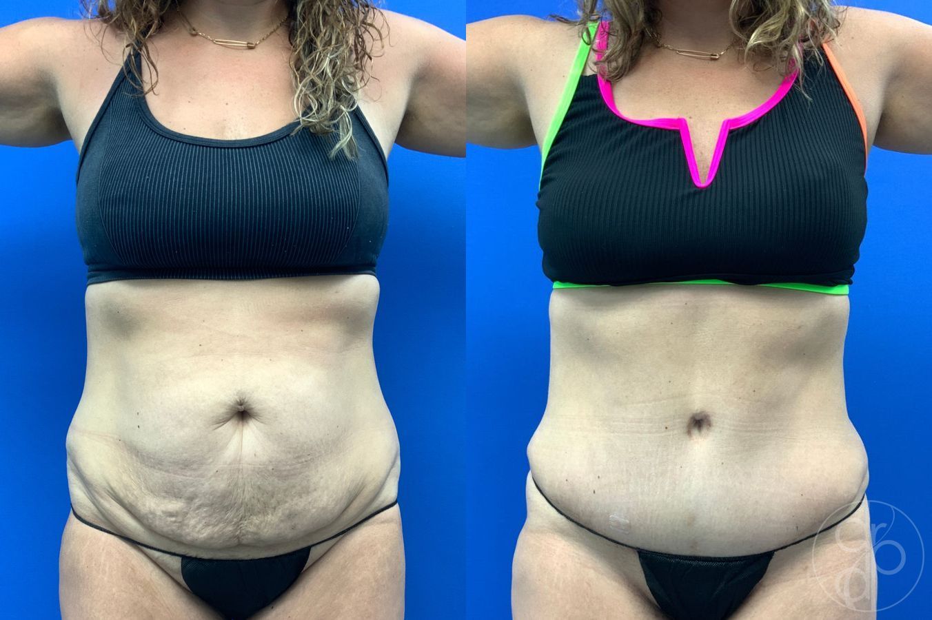 Before and after Liposuction case 43452 - Angle 2