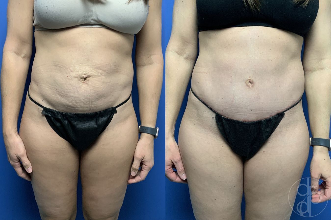 Before and after Abdominoplasty case 29580
