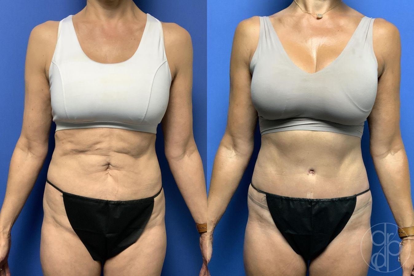 Before and after Abdominoplasty case 29647
