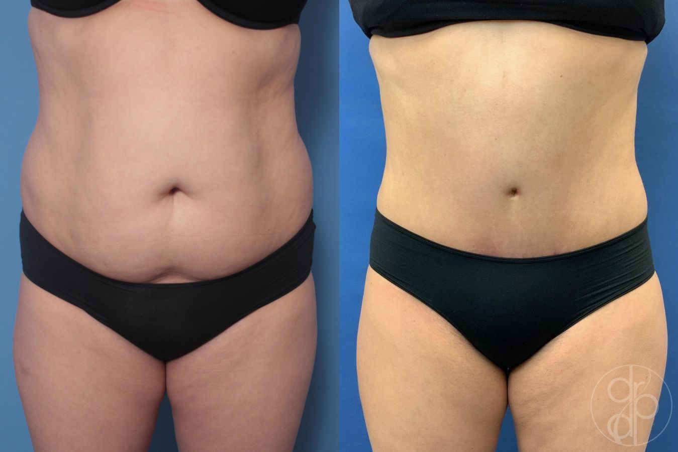 Before and after Liposuction case 29521