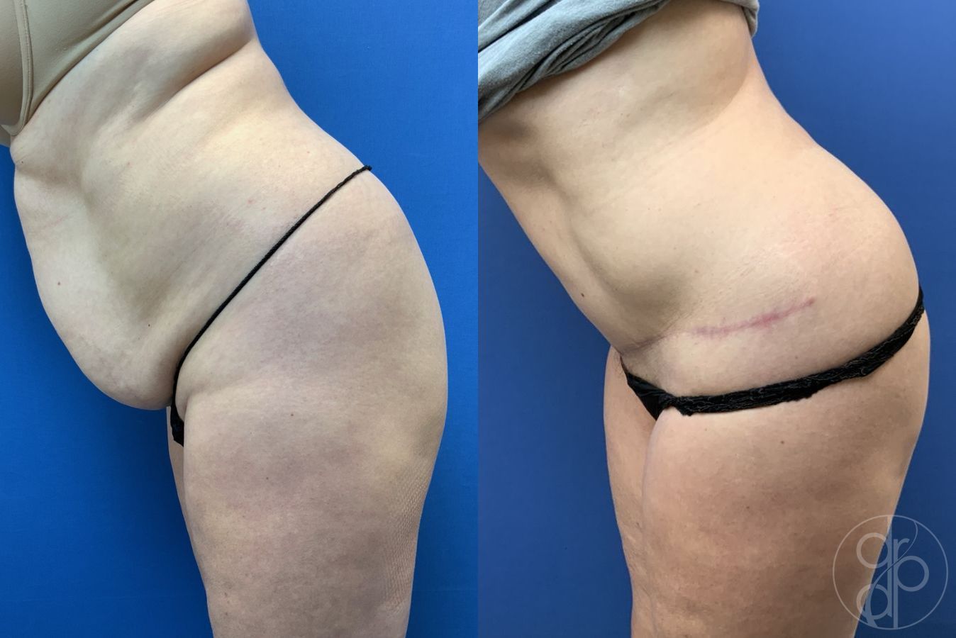 Before and after Abdominoplasty case 29579 - Angle 2