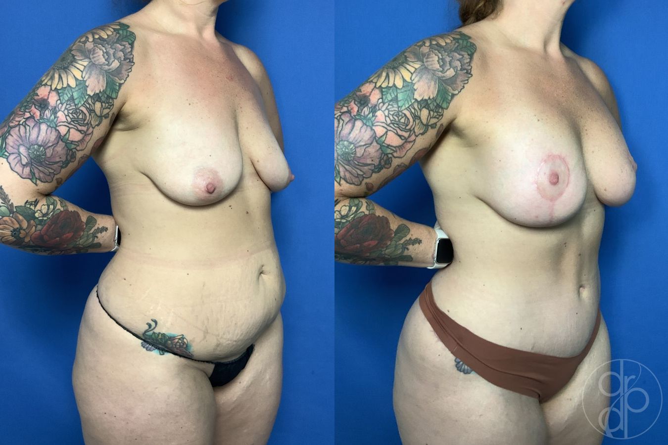 Before and after Abdominoplasty case 29689 - Angle 3