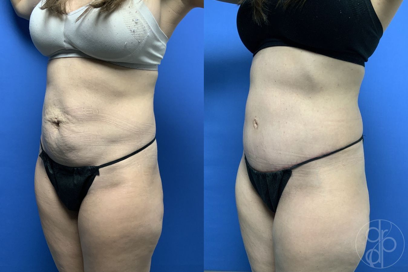 Before and after Abdominoplasty case 29580 - Angle 4