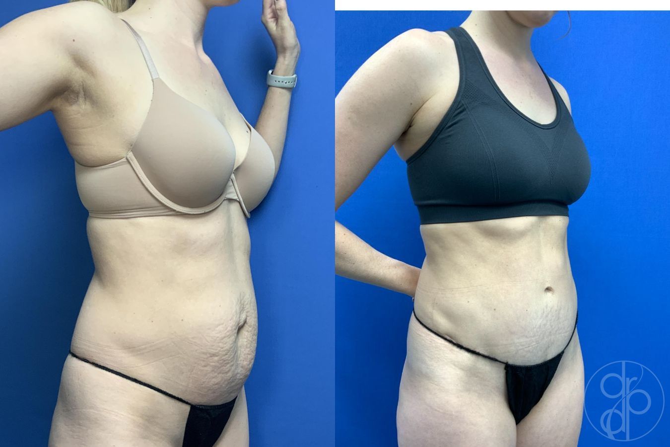 Before and after Abdominoplasty case 30012 - Angle 4
