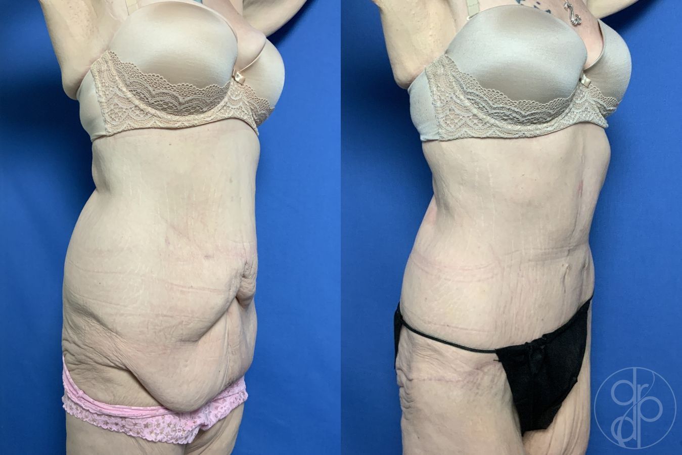 Abdominoplasty - Thumbnail 2