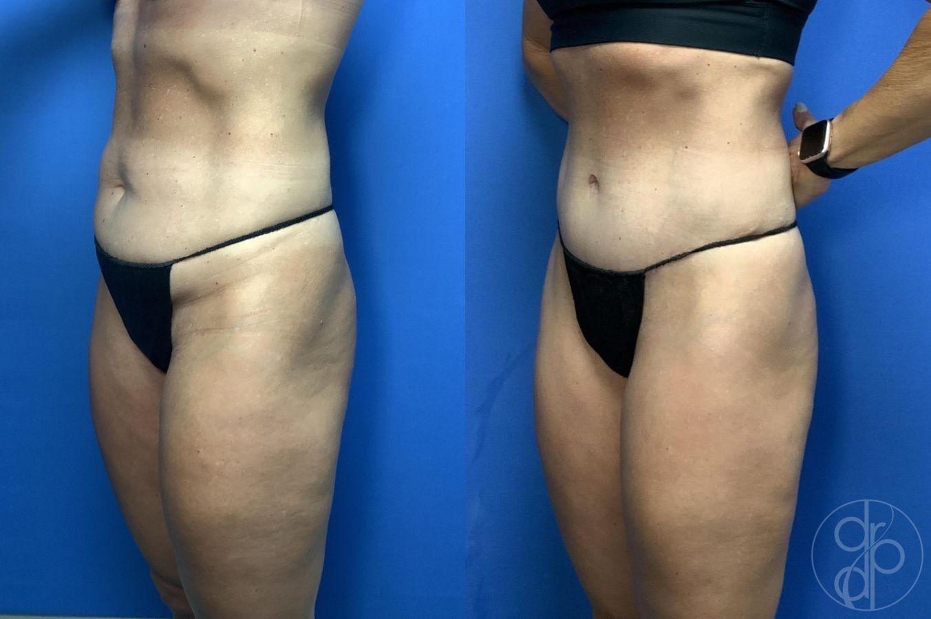 Before and after Abdominoplasty case 29994 - Angle 2